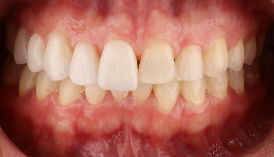 Caso clínico de laminados cerâmicos recém-cimentados, vista intraoral
