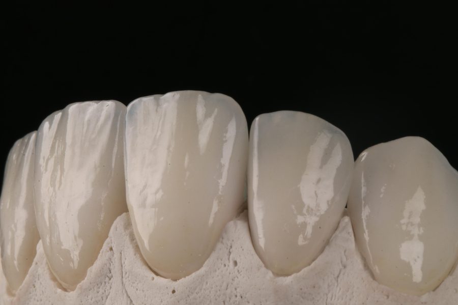 Laminados cerâmicos montados em modelo, mostrando acabamento e translucidez