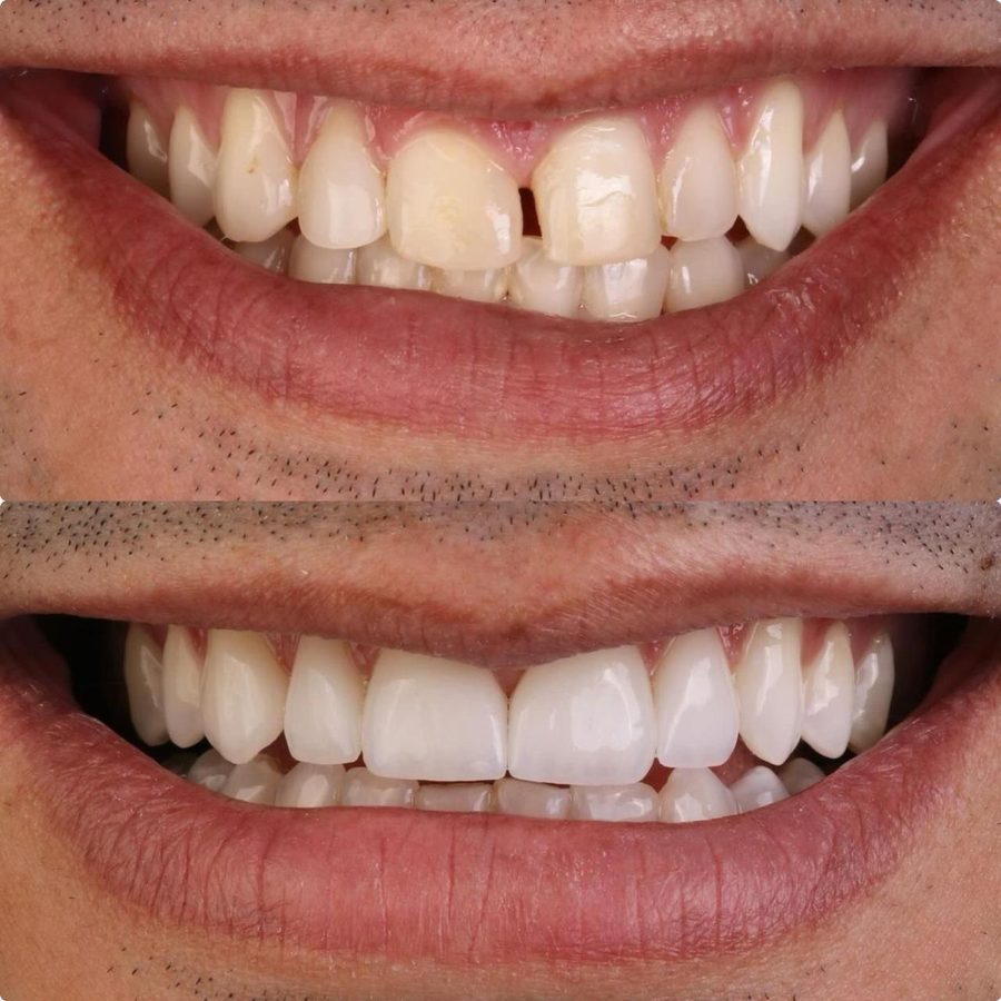 Antes e depois de tratamento com laminados cerâmicos
