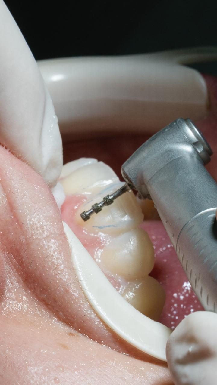 Preparo dentário para laminados cerâmicos realizado durante aula prática