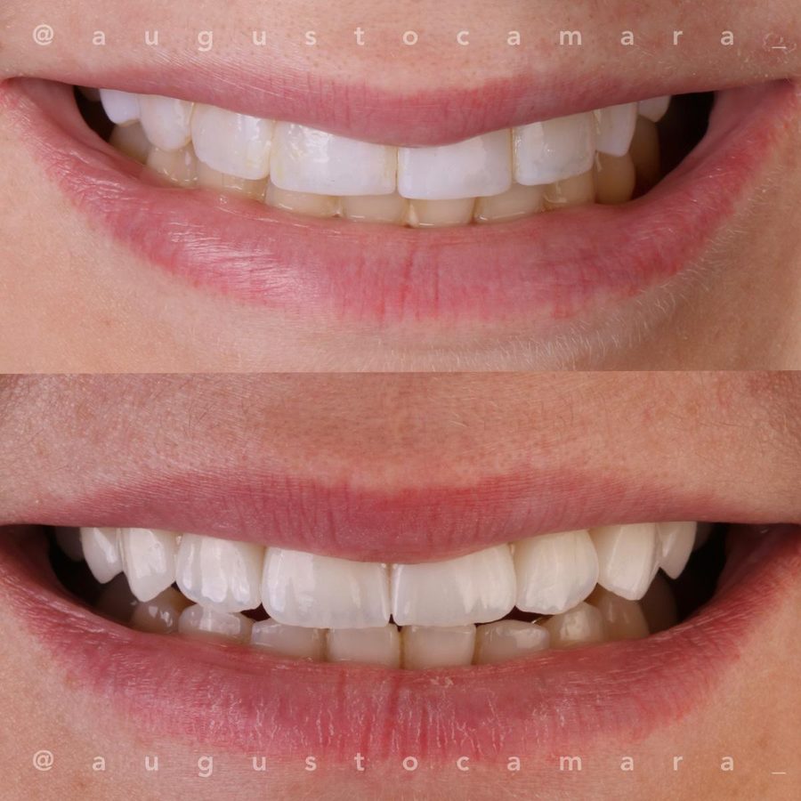 Antes e depois de sorriso tratado com laminados cerâmicos, resultado final