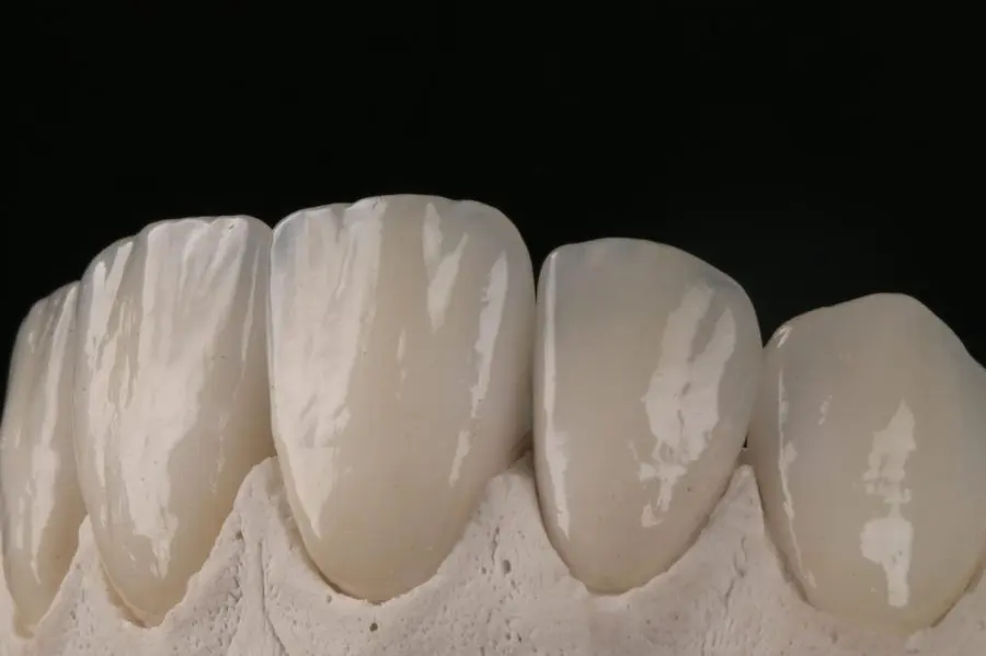 Laminados cerâmicos montados em modelo, mostrando acabamento e translucidez