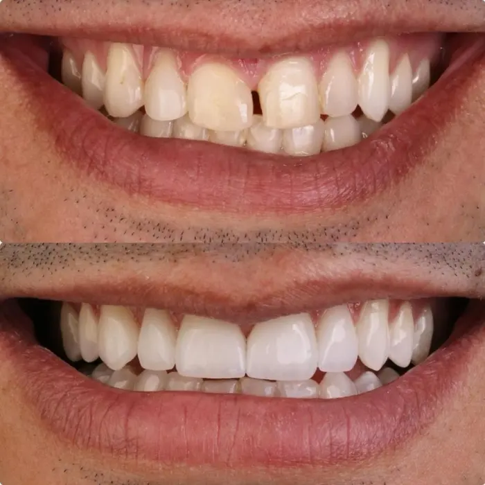 Antes e depois de tratamento com laminados cerâmicos