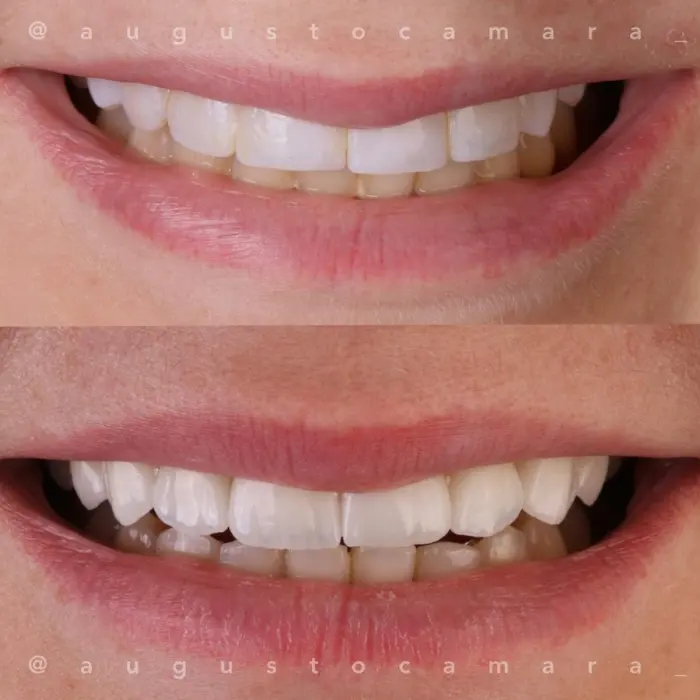 Antes e depois de sorriso tratado com laminados cerâmicos, resultado final